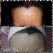 Лифтинг лица без операций. Выезд на дом Алматы