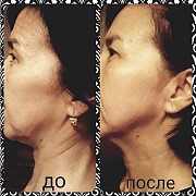 Лифтинг лица без операций. Выезд на дом Алматы