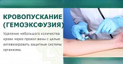 Венозное кровопускание при отеках ног к вечеру Алматы