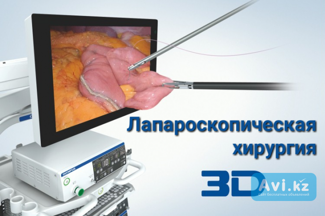 3D Лапароскопия Алматы хирург Игорь Никонов Алматы - изображение 1