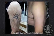 Лазерное выведение татуировок Алматы