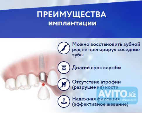 Имплантация зубов Астана - изображение 1