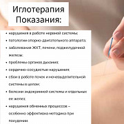 Иглоукалывание, иглотерапия, иглорефлексотерапия, акупунктура Алматы