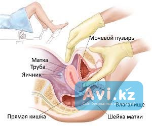 Гинекологический массаж, массаж матки, обучение Алматы - изображение 1