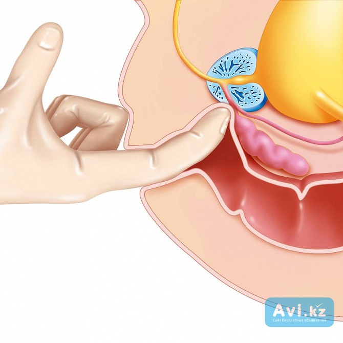 Урологический массаж, массаж простаты, обучение Алматы - изображение 1