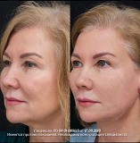 Эндолиф Усть-Каменогорск