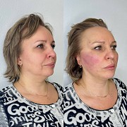 Эндолиф Усть-Каменогорск