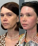 Эндолиф Усть-Каменогорск