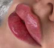 Косметолог увеличение губ Алматы