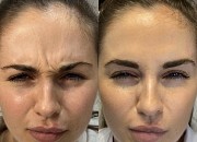 Косметолог увеличение губ Алматы