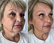 Косметолог увеличение губ Алматы