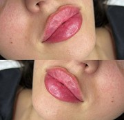 Косметолог увеличение губ Алматы