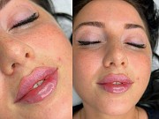 Косметолог увеличение губ Алматы