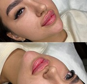 Косметолог увеличение губ Алматы